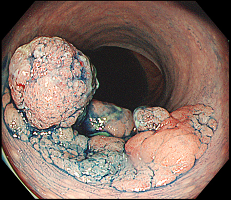 内視鏡治療で根治できた早期大腸がん