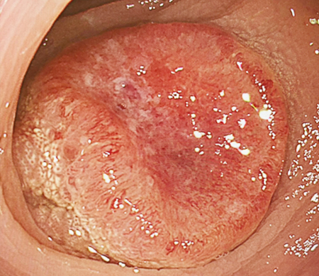 手術で根治が期待できる進行大腸がん